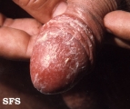balanitis candidomycetica