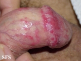 balanitis candidomycetica