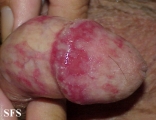 balanitis candidomycetica