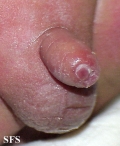 balanitis candidomycetica