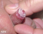 balanitis candidomycetica