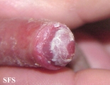 balanitis candidomycetica