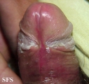 balanitis candidomycetica