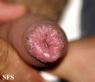 balanitis candidomycetica