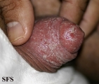 balanitis candidomycetica