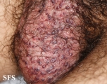 angiokeratoma of the scrotum