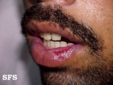 pseudo-epitheliomatous hiperplasia-cheilitis actinic