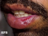 pseudo-epitheliomatous hiperplasia-cheilitis actinic