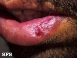 pseudo-epitheliomatous hiperplasia-cheilitis actinic