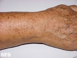 lentigo senilis