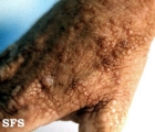 colloid milium