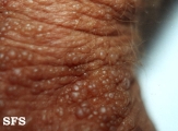 colloid milium