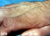 colloid milium