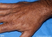 colloid milium