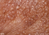 colloid milium
