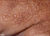 colloid milium