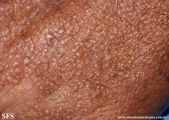colloid milium
