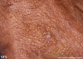colloid milium