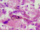 phaeohyphomycosis