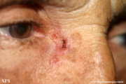 basal cell carcinoma