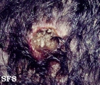 myiasis