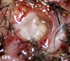 myiasis