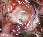myiasis