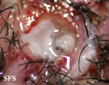 myiasis