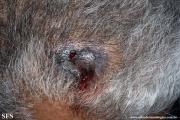 angiosarcoma