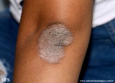 pityriasis rubra pilaris
