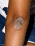 pityriasis rubra pilaris