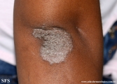 pityriasis rubra pilaris