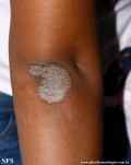 pityriasis rubra pilaris
