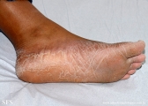 pityriasis rubra pilaris