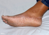 pityriasis rubra pilaris