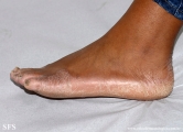 pityriasis rubra pilaris