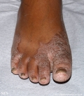 pityriasis rubra pilaris