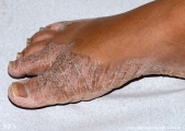 pityriasis rubra pilaris