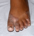 pityriasis rubra pilaris