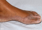 pityriasis rubra pilaris