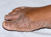 pityriasis rubra pilaris