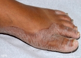 pityriasis rubra pilaris