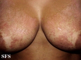 pityriasis rubra pilaris