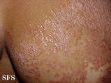 pityriasis rubra pilaris