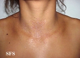 pityriasis rubra pilaris