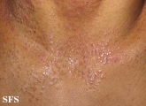 pityriasis rubra pilaris