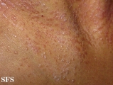 pityriasis rubra pilaris