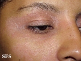 pityriasis rubra pilaris