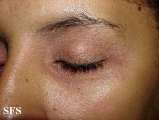 pityriasis rubra pilaris
