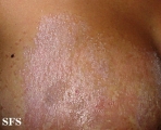 pityriasis rubra pilaris